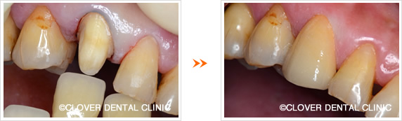 前歯のイーマックスクラウン