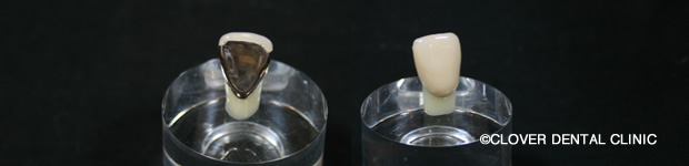 プラスチック前装冠