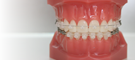歯並びをよくしたい大人の歯列矯正