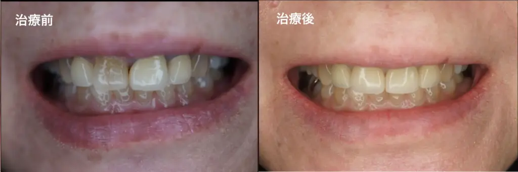 ビフォーアフター　前歯自費治療　ジルコニア