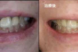 自費治療　前歯　ビフォーアフター