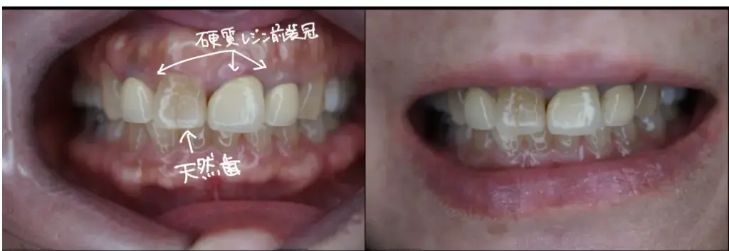 治療前　ビフォー　審美歯科