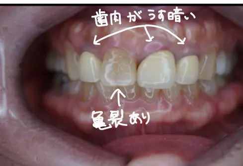 前歯破折　亀裂線　保険の前歯