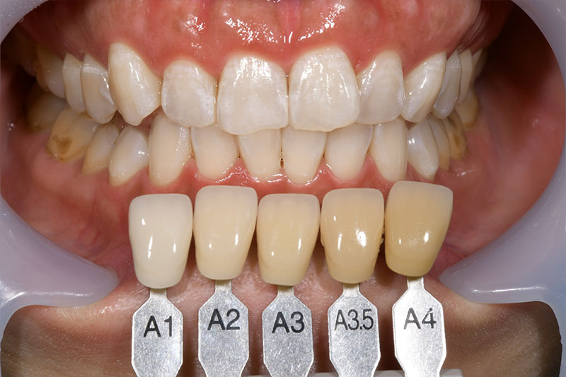 オフィスホワイトニング症例　登戸クローバー歯科