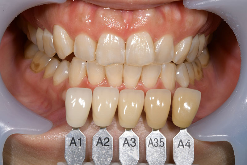 オフィスホワイトニング症例　登戸クローバー歯科