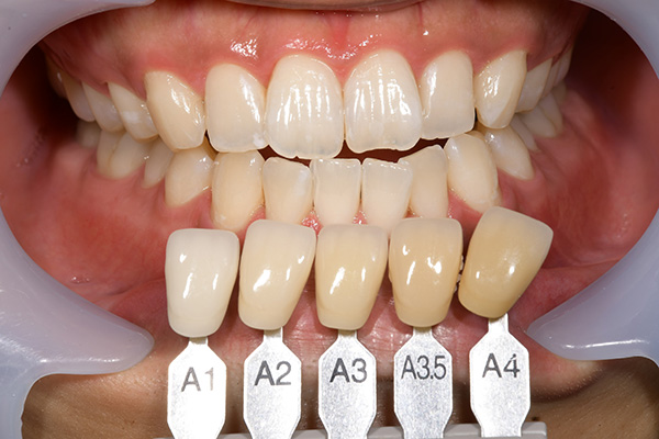case-whitening02-af