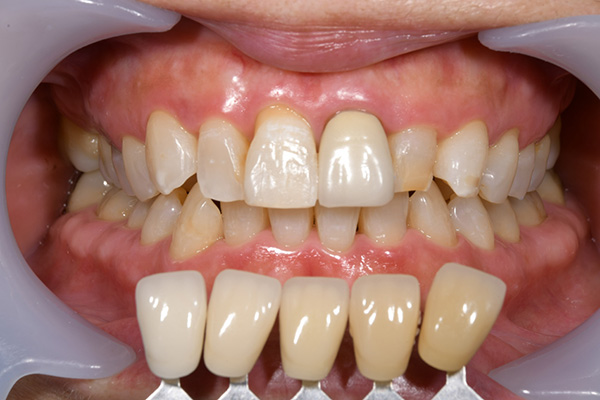 case-whitening03-af
