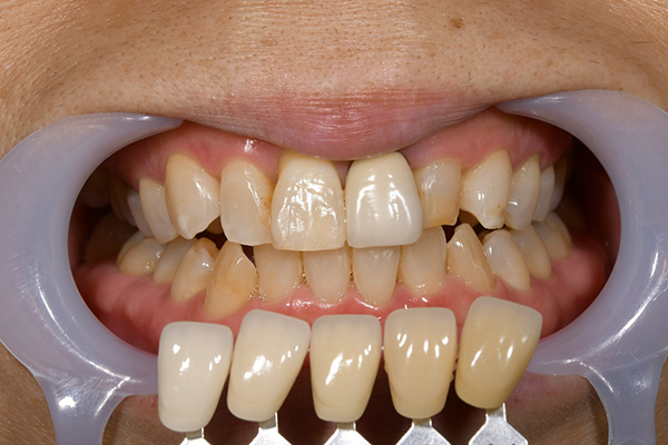 case-whitening03-bf