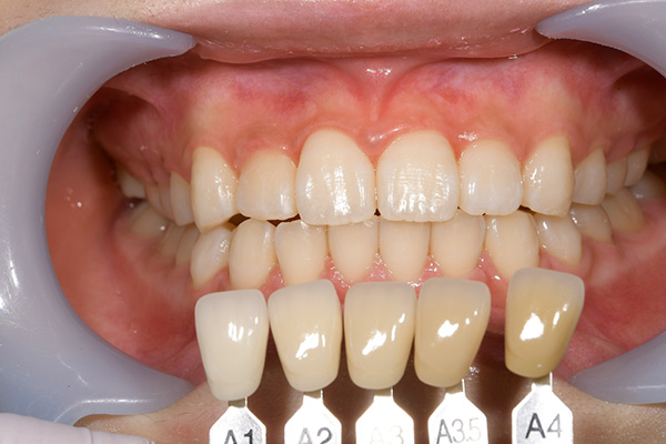 case-whitening04-af
