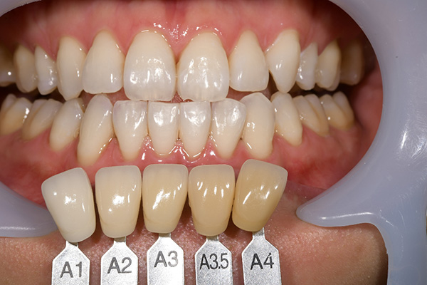 case-whitening05-af