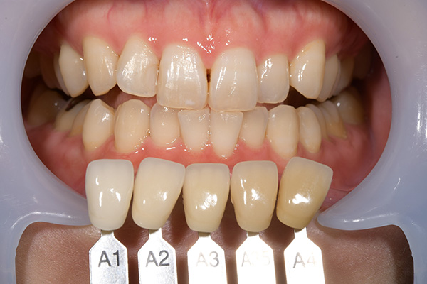 case-whitening06-af