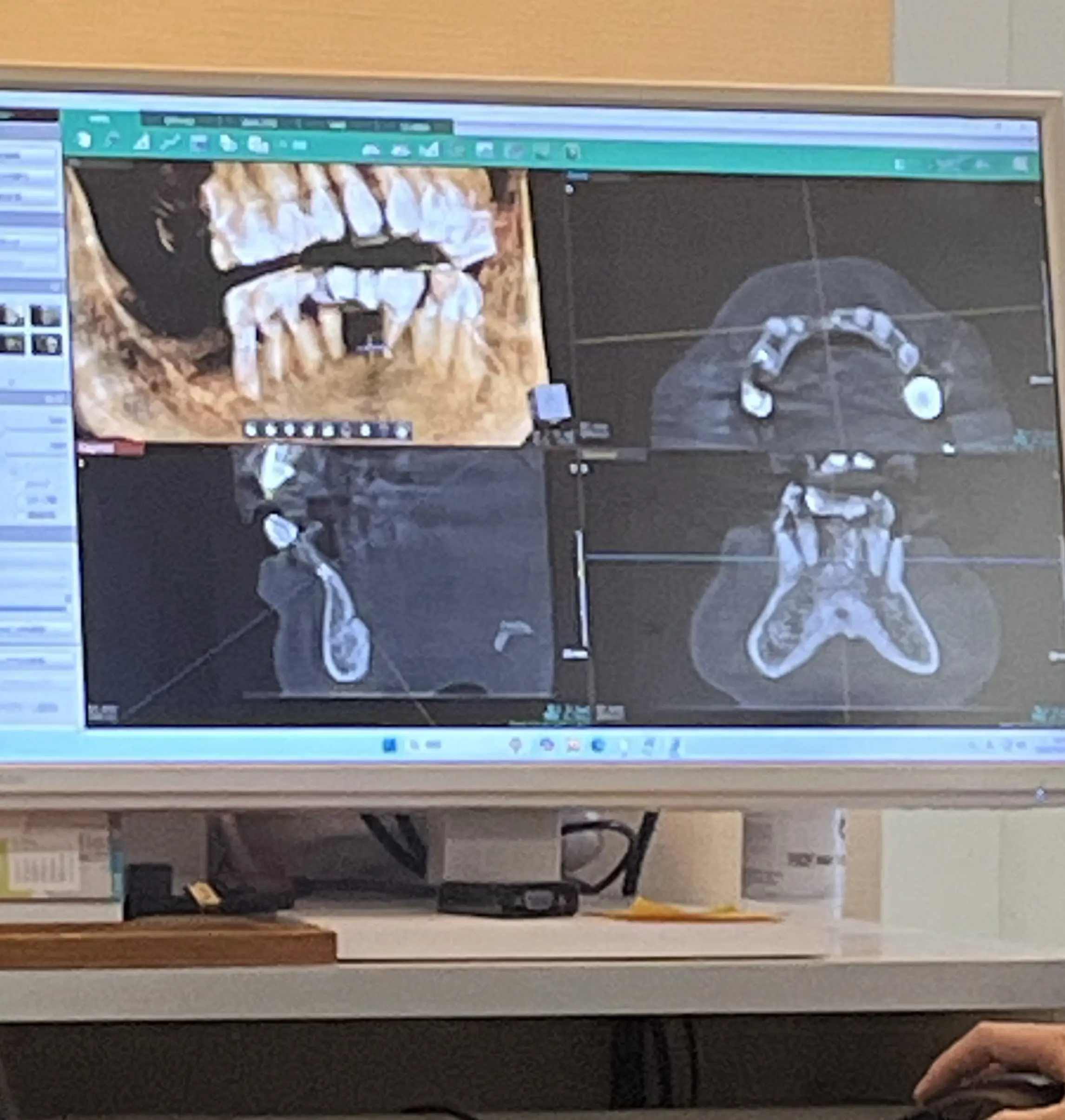 インプラント　GBR　骨造成