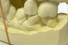 歯を失った　歯がない　インプラントしたい