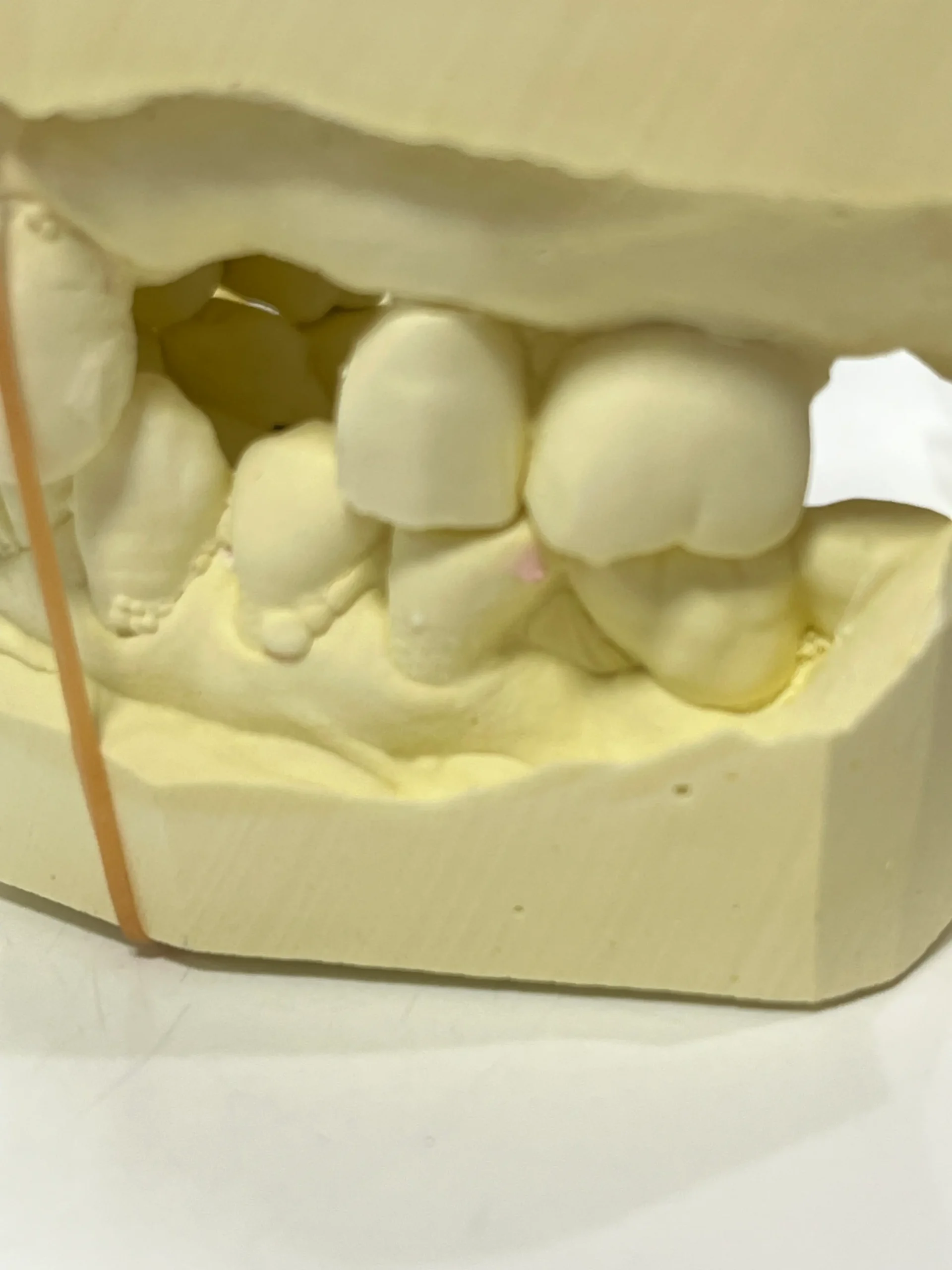 歯を失った　歯がない　インプラントしたい