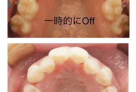 矯正後戻り　保定期間　矯正症例