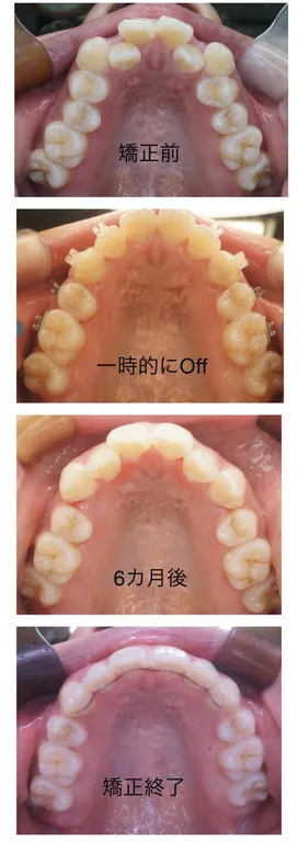 矯正症例　矯正中の後戻り　歯並び