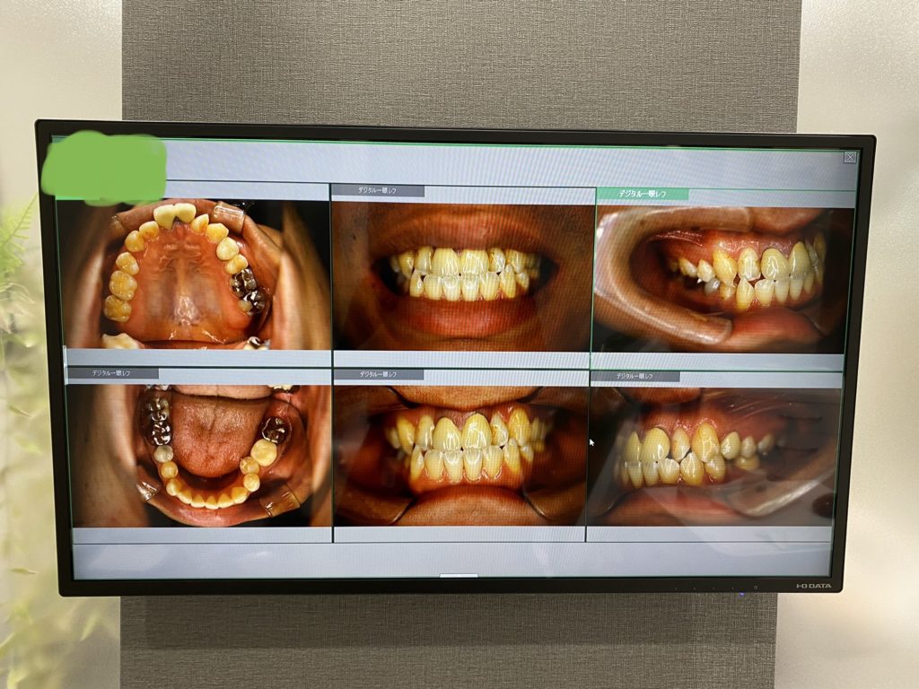 桜新町　歯医者　口腔内写真