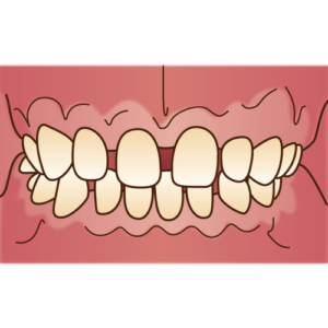 すきっ歯　矯正　歯並び