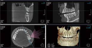 歯科　CT　診断