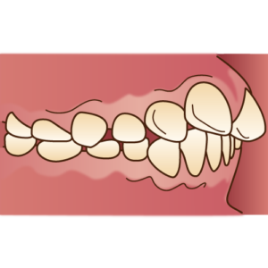 上顎前突　出っ歯　矯正
