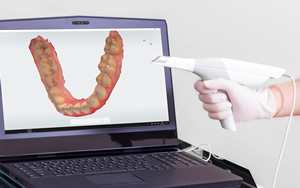 口腔内スキャナー　診断　マウスピース