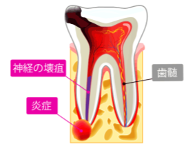 根の治療　膿　歯の痛み