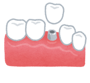 インプラント　治療の流れ　インプラント相談