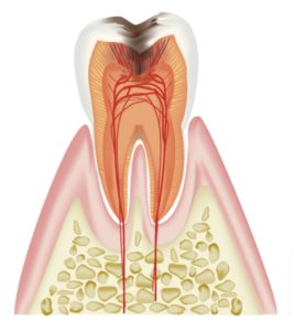 歯の断面図　虫歯になる流れ　虫歯