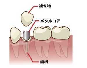 神経の無い歯　抜髄後　歯の変色