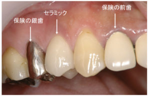 歯の被せ物　セラミックの歯　保険の被せ物