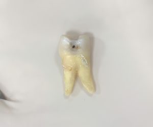 虫歯　歯が溶ける　歯の写真